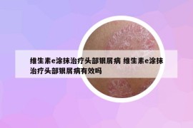 维生素e涂抹治疗头部银屑病 维生素e涂抹治疗头部银屑病有效吗