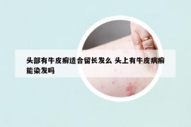 头部有牛皮癣适合留长发么 头上有牛皮病癣能染发吗