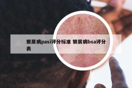 银屑病pasi评分标准 银屑病bsa评分表