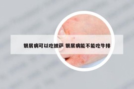 银屑病可以吃披萨 银屑病能不能吃牛排