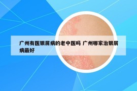 广州有医银屑病的老中医吗 广州哪家治银屑病最好