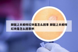 脚腿上长癣样红块是怎么回事 脚腿上长癣样红块是怎么回事啊