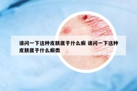 请问一下这种皮肤属于什么癣 请问一下这种皮肤属于什么癣类