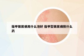 指甲银屑病用什么泡好 指甲型银屑病擦什么药