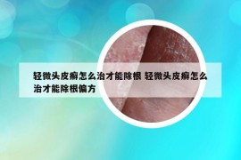 轻微头皮癣怎么治才能除根 轻微头皮癣怎么治才能除根偏方