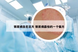 银屑病自愈豆方 银屑病最怕的一个偏方