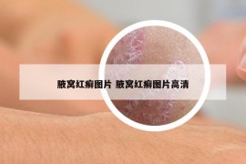 腋窝红癣图片 腋窝红癣图片高清