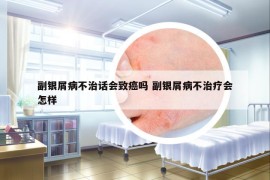 副银屑病不治话会致癌吗 副银屑病不治疗会怎样