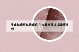 牛皮肤癣可以拔罐吗 牛皮肤癣可以拔罐吗视频