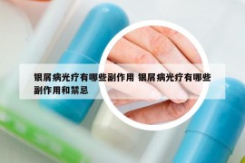 银屑病光疗有哪些副作用 银屑病光疗有哪些副作用和禁忌