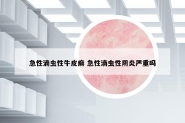 急性滴虫性牛皮癣 急性滴虫性阴炎严重吗