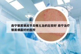 南宁银屑病关节炎哪儿治的比较好 南宁治疗银屑病最好的医院