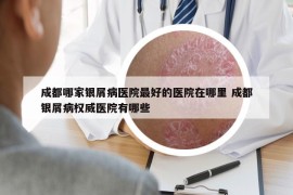 成都哪家银屑病医院最好的医院在哪里 成都银屑病权威医院有哪些