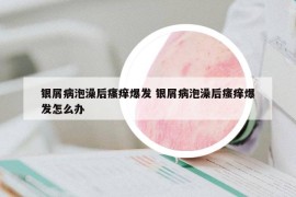 银屑病泡澡后瘙痒爆发 银屑病泡澡后瘙痒爆发怎么办