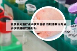 氨肽素片治疗点滴状银屑病 氨肽素片治疗点滴状银屑病效果好吗