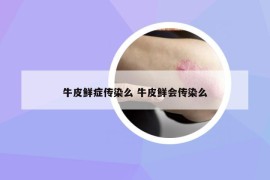 牛皮鲜症传染么 牛皮鲜会传染么