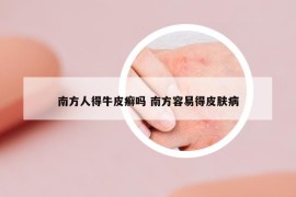 南方人得牛皮癣吗 南方容易得皮肤病