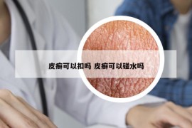 皮癣可以扣吗 皮癣可以碰水吗