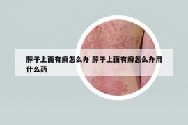 脖子上面有癣怎么办 脖子上面有癣怎么办用什么药