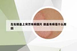 左右膝盖上突然有癣图片 膝盖有癣是什么原因