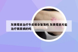 灰黄霉素治疗牛皮癣会复发吗 灰黄霉素片能治疗银屑病的吗