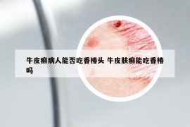 牛皮癣病人能否吃香椿头 牛皮肤癣能吃香椿吗