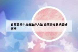 日照民间牛皮癣治疗方法 日照治皮肤病最好医院