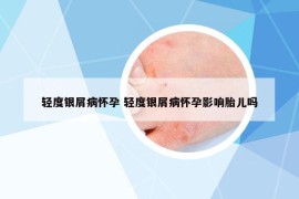 轻度银屑病怀孕 轻度银屑病怀孕影响胎儿吗