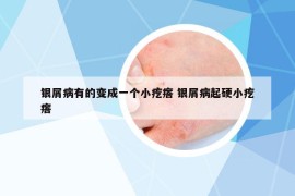 银屑病有的变成一个小疙瘩 银屑病起硬小疙瘩