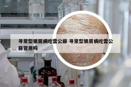 寻常型银屑病吃雷公藤 寻常型银屑病吃雷公藤管用吗