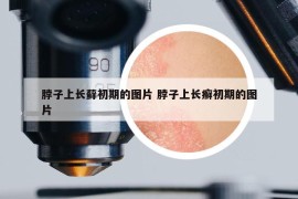 脖子上长藓初期的图片 脖子上长癣初期的图片