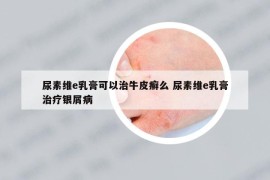 尿素维e乳膏可以治牛皮癣么 尿素维e乳膏治疗银屑病