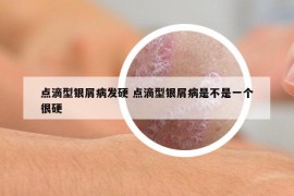 点滴型银屑病发硬 点滴型银屑病是不是一个很硬