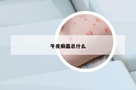 牛皮癣最忌什么