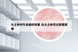 凡士林对牛皮癣的效果 白凡士林可以擦银屑病