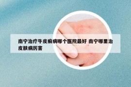 南宁治疗牛皮癣病哪个医院最好 南宁哪里治皮肤病厉害