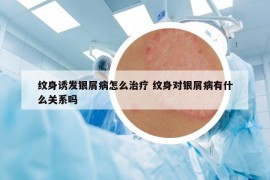 纹身诱发银屑病怎么治疗 纹身对银屑病有什么关系吗