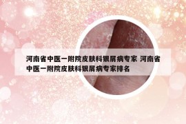 河南省中医一附院皮肤科银屑病专家 河南省中医一附院皮肤科银屑病专家排名