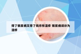 得了银屑病又得了钱币样湿疹 银屑病误诊为湿疹