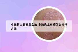 小孩头上长癣怎么治 小孩头上有癣怎么治疗方法