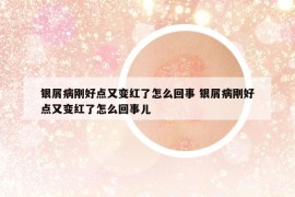 银屑病刚好点又变红了怎么回事 银屑病刚好点又变红了怎么回事儿