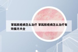 掌跖脓疱病怎么治疗 掌跖脓疱病怎么治疗有效偏方大全