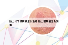 脸上长了银屑病怎么治疗 脸上银屑病怎么消退