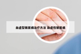 血虚型银屑病治疗方法 血虚性银屑病