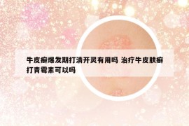 牛皮癣爆发期打清开灵有用吗 治疗牛皮肤癣打青霉素可以吗