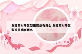 鱼腥草对寻常型银屑病有用么 鱼腥草对寻常型银屑病有用么