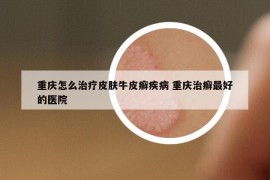 重庆怎么治疗皮肤牛皮癣疾病 重庆治癣最好的医院