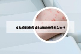 皮肤癣都痒吗 皮肤癣都痒吗怎么治疗