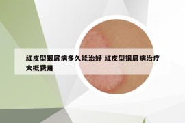 红皮型银屑病多久能治好 红皮型银屑病治疗大概费用