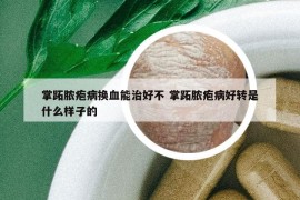 掌跖脓疱病换血能治好不 掌跖脓疱病好转是什么样子的